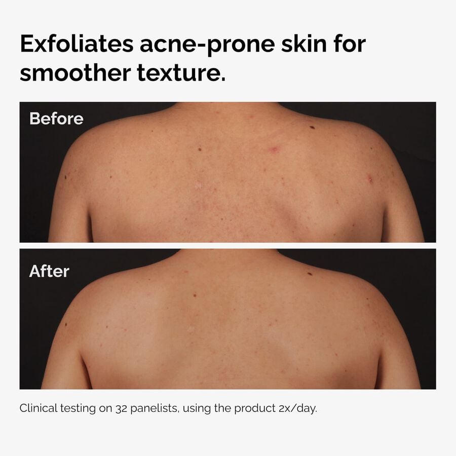 the-body-care-collection-q4 ord-salicylic-acid-body-serum-before-after-graphic-NA.jpg