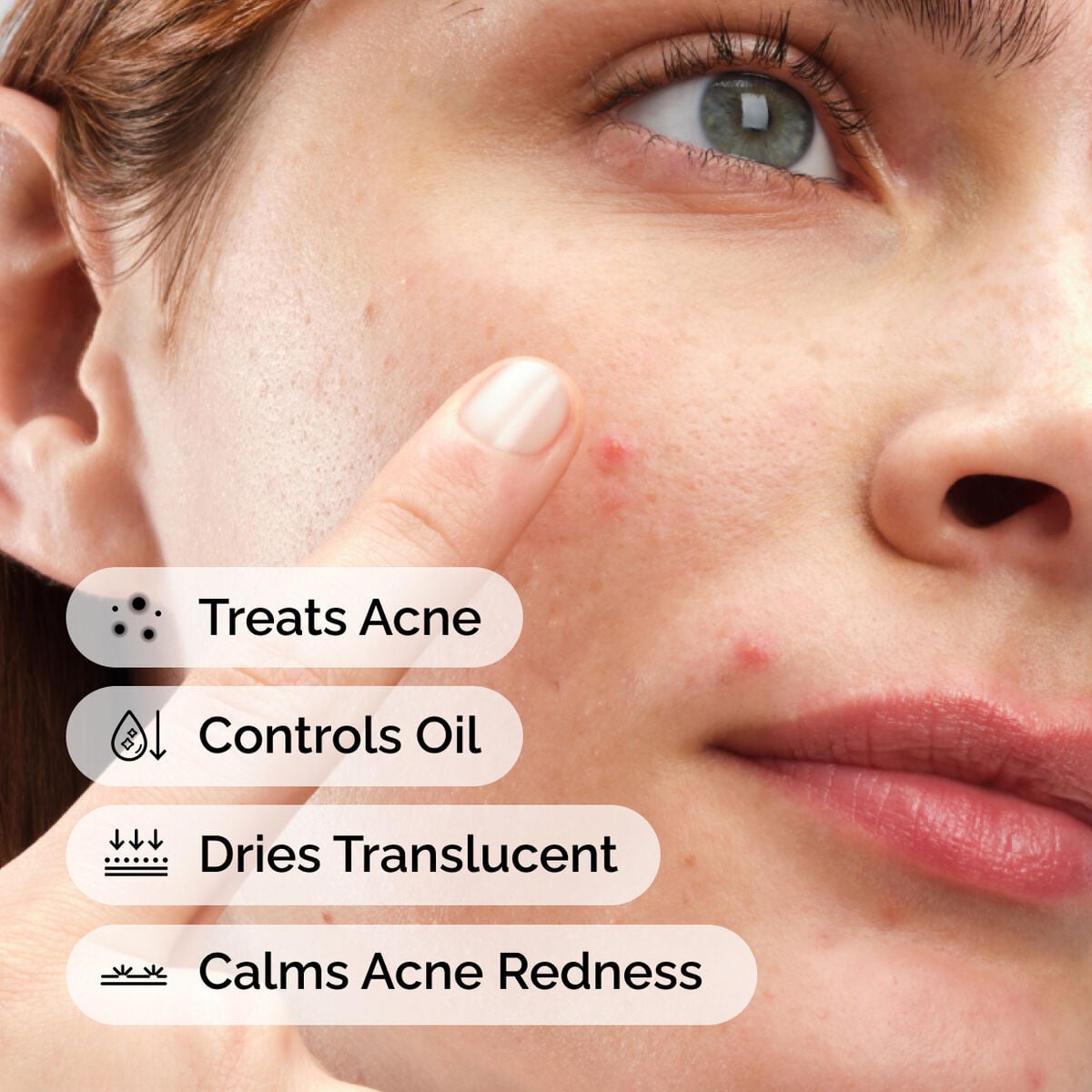 sulfur-10-powder-to-cream-concentrate-g1 ord-sulfur-10pct-powder-to-cream-concentrate-model-application-with-benefits-acne.jpg